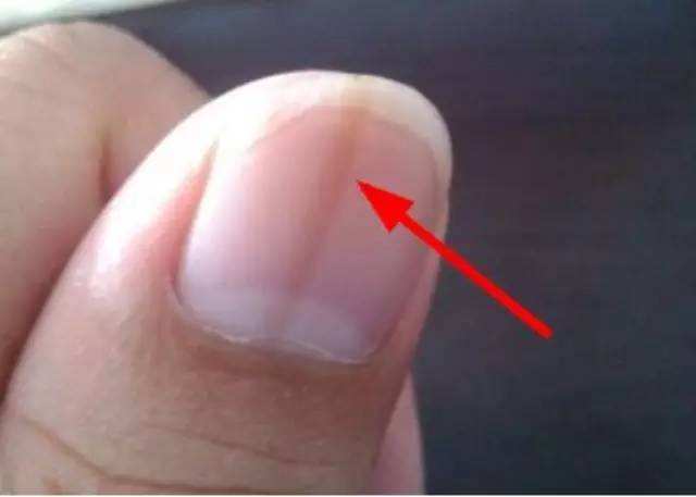 指甲为什么长竖纹 指甲上的竖纹意味什么