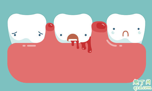 长期缺维生素牙龈会一直出血吗 洗牙能让牙龈在也不流血吗1