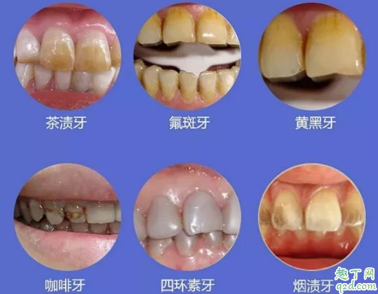 Whitewash牙贴怎么样 Whitewash牙贴使用评测及注意事项3