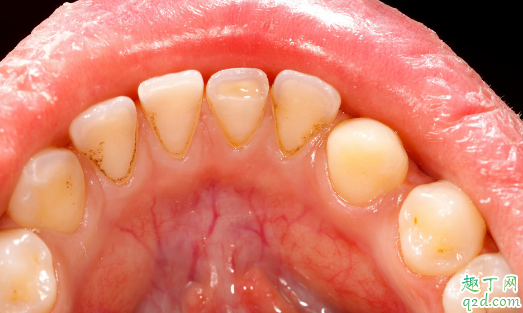 牙结石该不该清理 日常如何预防牙结石3
