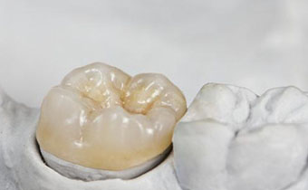 牙结石该不该清理 日常如何预防牙结石