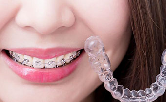 牙套的种类有哪些 哪种牙套矫正牙齿效果更好