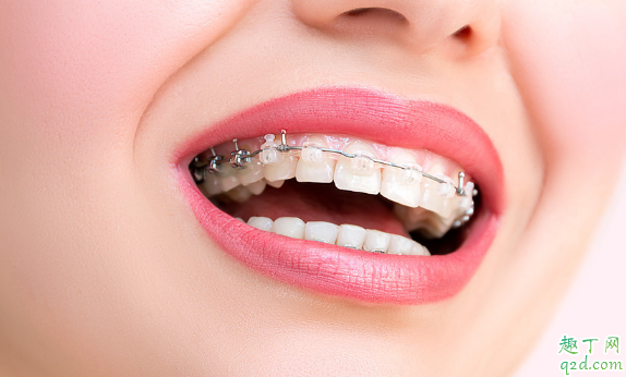 牙套的种类有哪些 哪种牙套矫正牙齿效果更好2