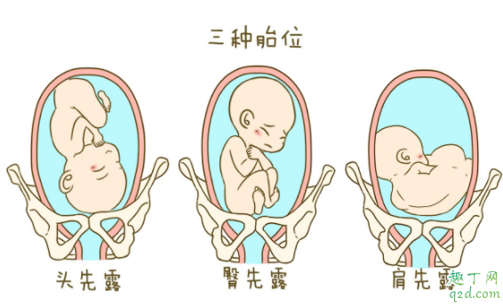 怎么看胎位是不是横位 胎儿横位怎么矫正胎位2
