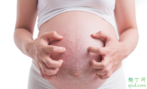 怀孕|怀孕没妊娠纹产后有了怎么回事 产后健身过度会导致妊娠纹吗