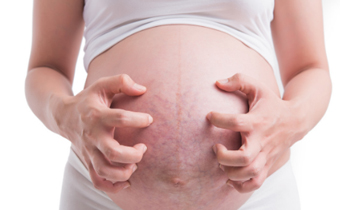 怀孕没妊娠纹产后有了怎么回事 产后健身过度会导致妊娠纹吗