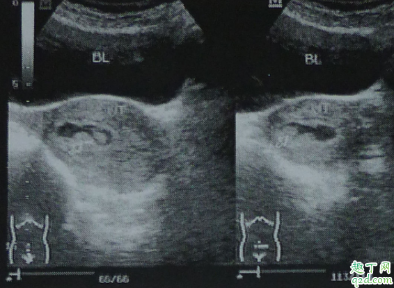 怀孕九周b超数据能看出男孩女孩吗 b超怎么看怀孕几个月3