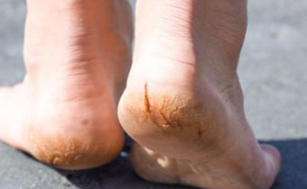 老人脚脱皮开裂怎么办 如何缓解脚跟干裂带来的疼痛