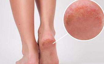秋季脚后跟开裂是啥引起的 治疗脚后跟干裂的方法有哪些