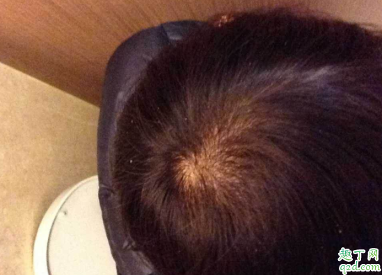 如何预防秃顶掉发 为什么男生比女生容易秃头1