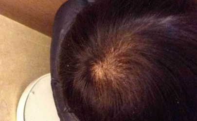 如何预防秃顶掉发 为什么男生比女生容易秃头