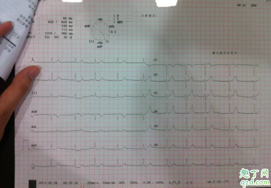 心电图正常心脏正常吗 确诊冠心病做哪些检查4
