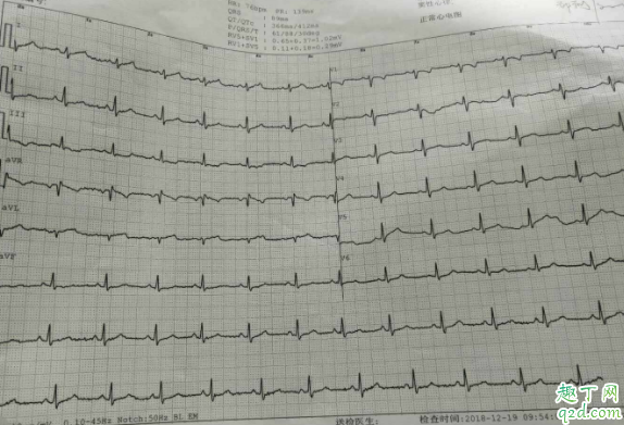 心电图查冠心病准确吗 心衰做心电图可以看得出来吗3