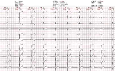 心电图正常心脏正常吗 确诊冠心病做哪些检查