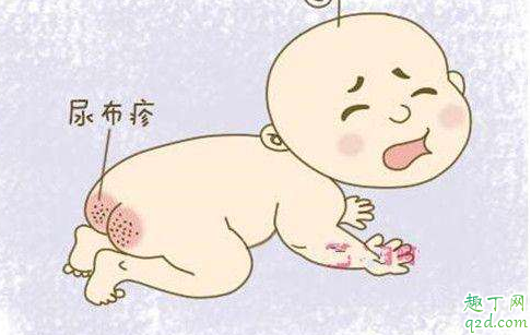 宝宝特别容易得尿布疹怎么办 宝宝为什么会有尿布疹3