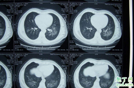 做CT检查共用设备会不会感染新冠 CT做多了会不会致癌 2