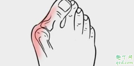 拇指外翻用手揉管用吗 拇外翻能导致脚掌疼吗2