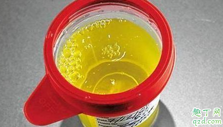小便发黄喝水多是什么原因 尿黄是在排湿气吗3