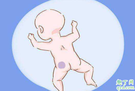 宝宝出生后屁股上有乌青怎么回事 如何防止新生儿出现乌青 2