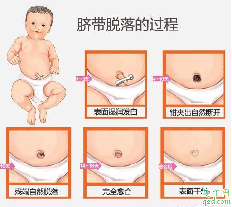 新生儿肚脐多长时间能痊愈 脐带未脱落前能给宝宝穿纸尿裤吗 2