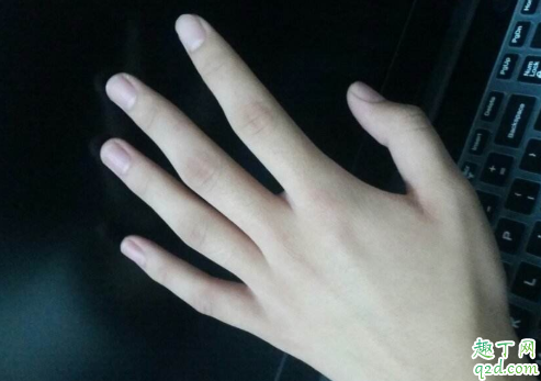 手指甲发黑是什么病 灰指甲是营养不良引起的吗3