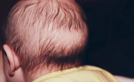 婴儿头发秃一圈是缺钙吗？枕秃了解一下！1