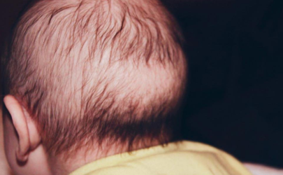 婴儿头发秃一圈是缺钙吗？枕秃了解一下！