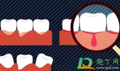 牙龈出血什么办法可以止血4