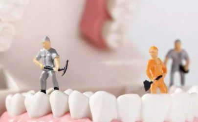 牙结石不洗牙有别的方法吗