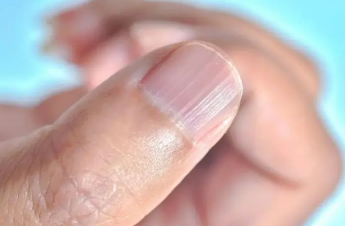 指甲|指甲有竖纹是身体的什么信号
