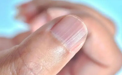 指甲有豎紋是身體的什么信號