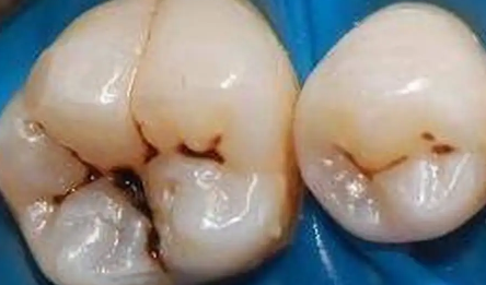 牙齿缝隙有黑黑的抠不下来还疼3