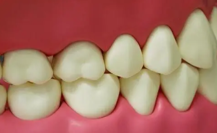 磨牙是什么原因引起的如何治疗2