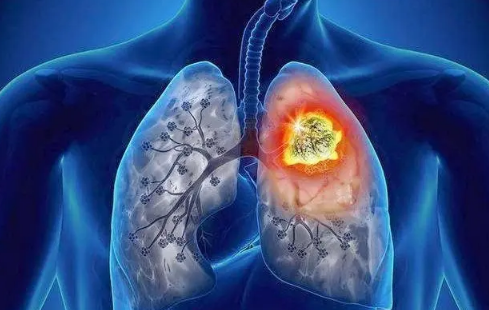 为什么不抽烟也可能得肺癌2