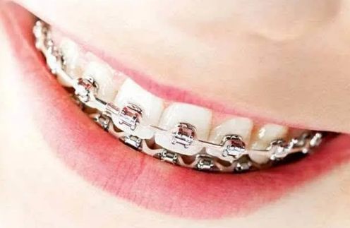 2022高考戴牙套需要证明吗3