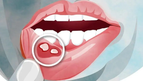 口腔溃疡怎么办最快最有效的方法	2