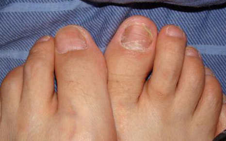 灰指甲是一种由真菌感染引起的疾病会感染其他健康的指甲