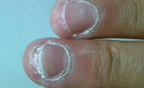 灰指甲要刮多薄指甲才能涂药2