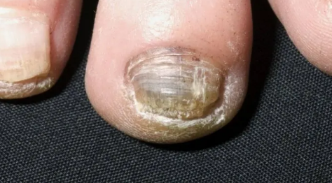 脚上灰指甲的危害性有多严重3