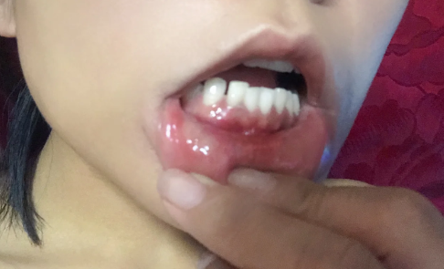牙龈也会口腔溃疡吗