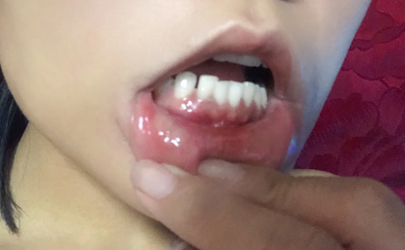 牙齦也會口腔潰瘍嗎