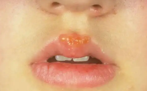 嘴唇|嘴唇起疱疹之后干巴巴的涂抹啥