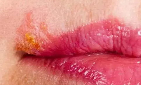 为什么每年嘴唇都长一次疱疹