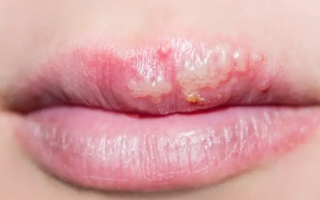 为什么每年嘴唇都长一次疱疹2