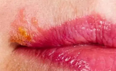 为什么每年嘴唇都长一次疱疹