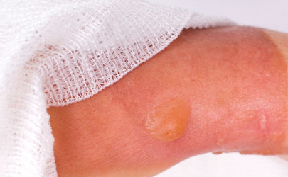 低温烫伤可导致皮肤深层组织坏死吗