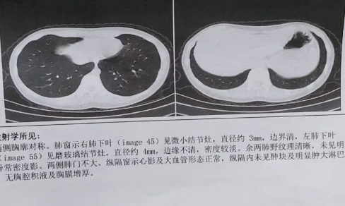 什么情況需要做肺部CT2