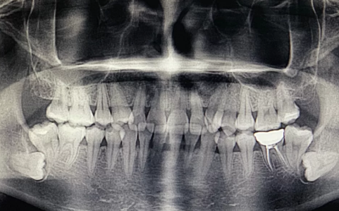 为什么牙医总喜欢劝人拔智齿3