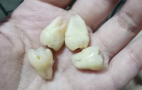 为什么有的牙齿有2个牙根有的没有1