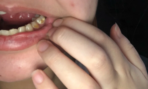 每个洗牙的医生都说有牙周炎是真的吗2